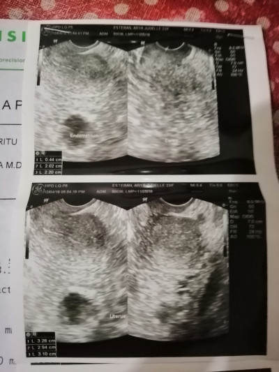 Transvaginal ultrasound?