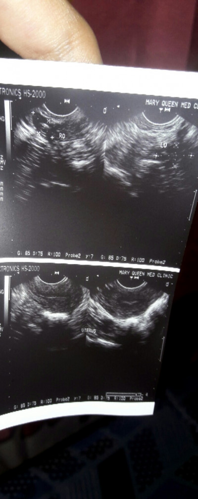 Accurate ba ang ultrasound kahit 1 month palang after sex?